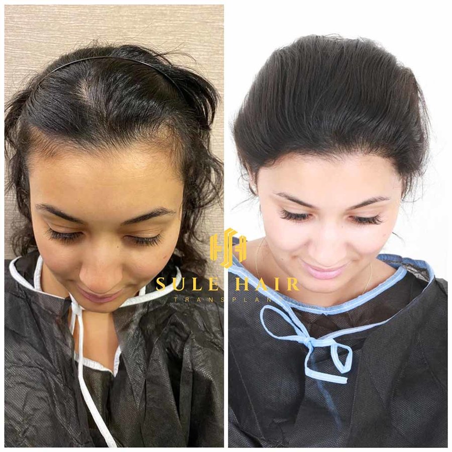 Sule Hair Transplant - Sule Hair Transplant