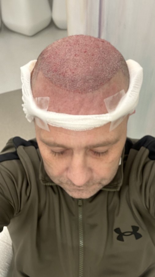 Sule Hair Transplant - Sule Hair Transplant