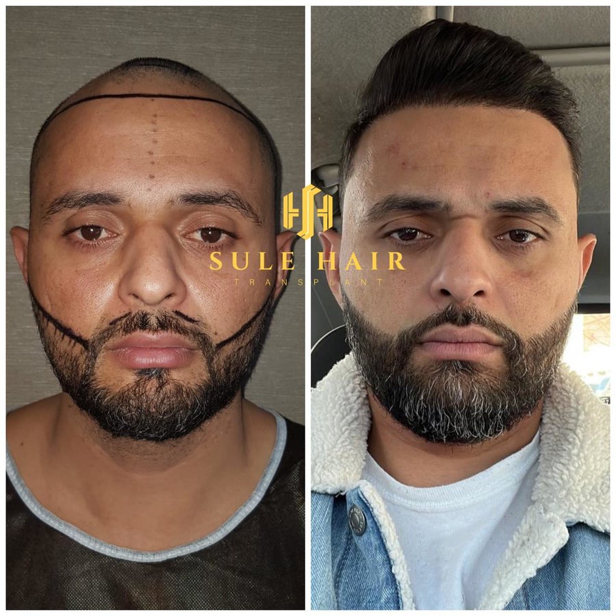 Sule Hair Transplant - Sule Hair Transplant