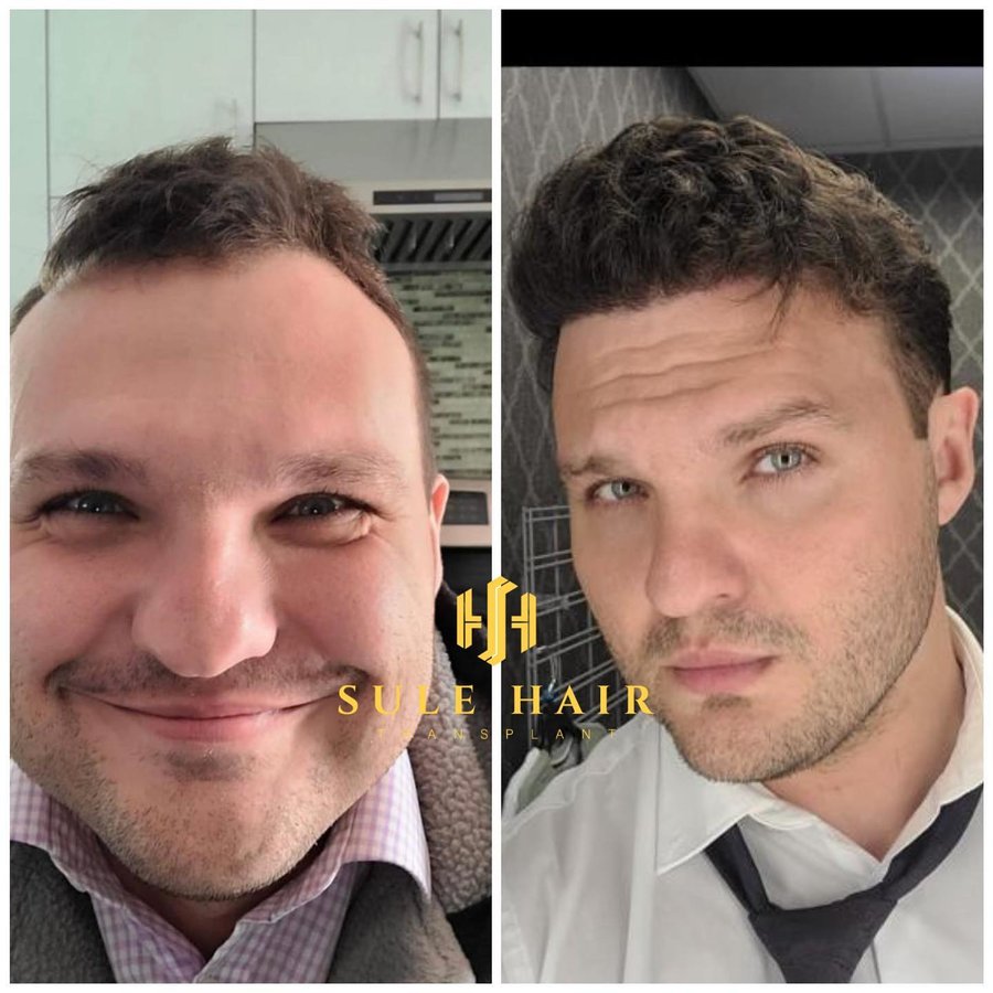 Sule Hair Transplant - Sule Hair Transplant