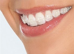 Sunshine Coast Fast Braces - Sunshine Coast Fast Braces