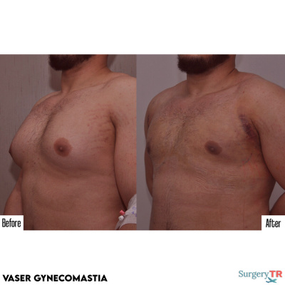 Surgery TR  - Surgery TR 