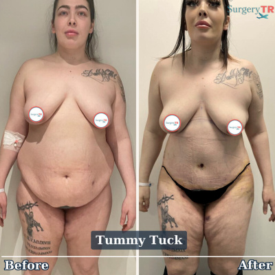 Surgery TR  - Surgery TR 