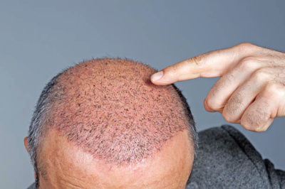 Tajmeels Clinic - Hair Transplant in Dubai