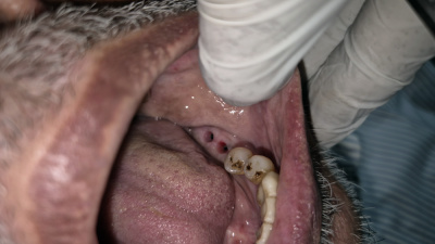 Teeth Care Multispeciality Dental Clinic - Dental Implant