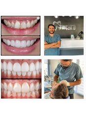 Teeth Veners تركيا - TEETH VENEERS TURKEY