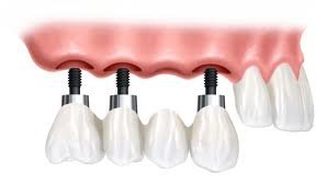 Thangams Dental Implant Center - Thangams Dental Implant Center