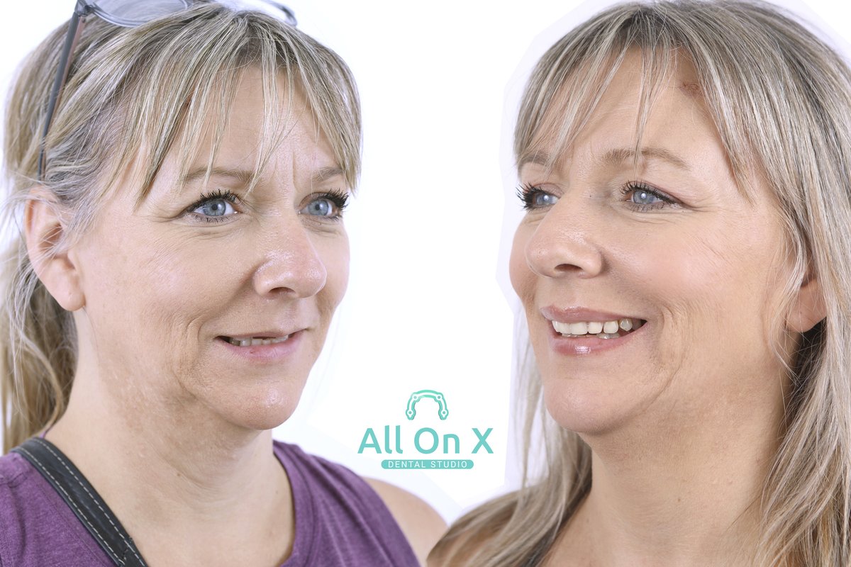 The All on X Dental Studio - The All on X Dental Studio