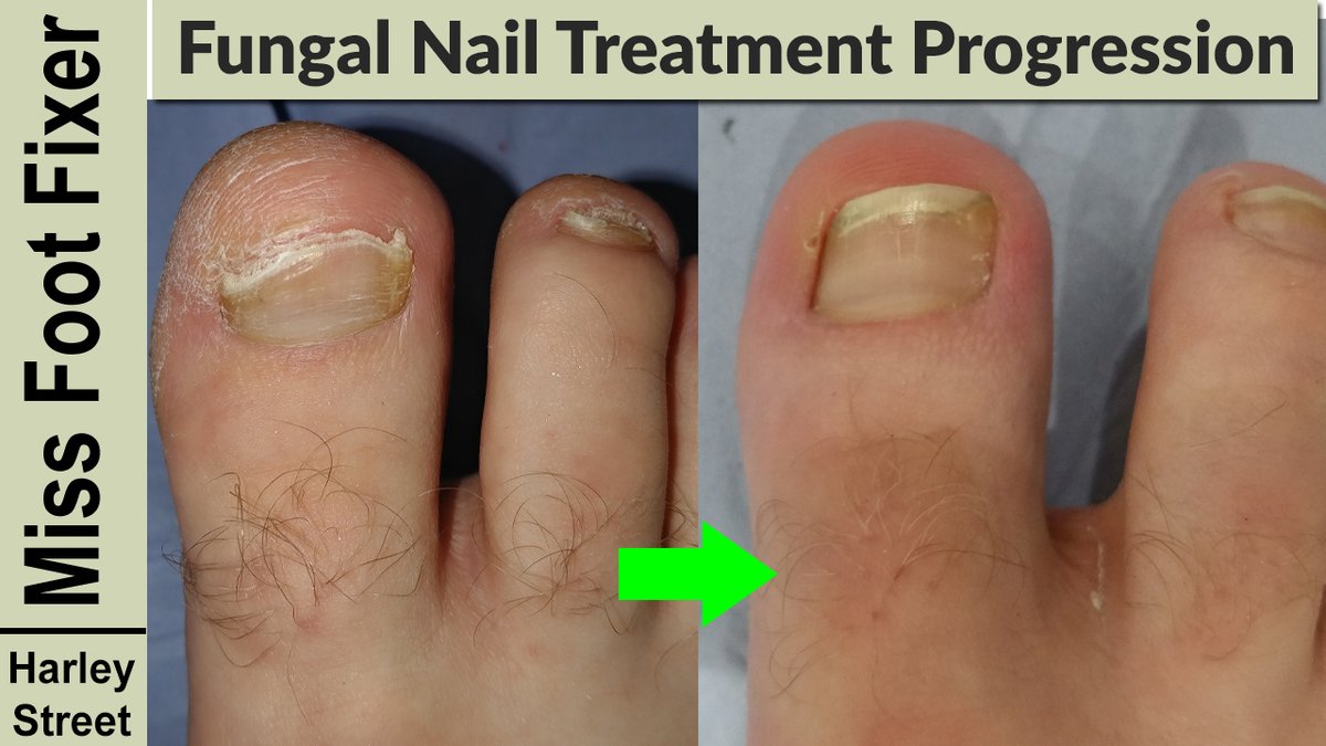 The Harley Medical Foot and Nail Laser Clinic: Marion Yau - The Harley Medical Foot and Nail Laser Clinic: Marion Yau