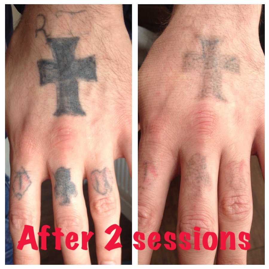 The Missing Ink: Laser Tattoo Removal - The Missing Ink: Laser Tattoo Removal