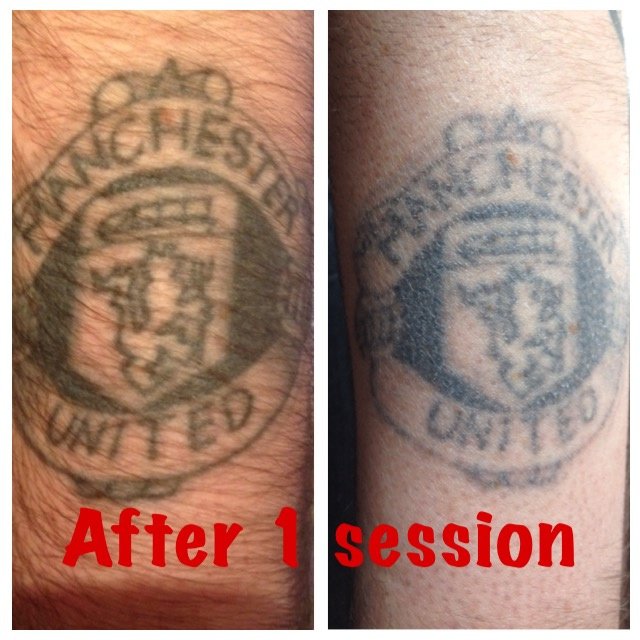 The Missing Ink: Laser Tattoo Removal - The Missing Ink: Laser Tattoo Removal