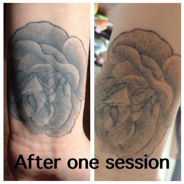 The Missing Ink: Laser Tattoo Removal - The Missing Ink: Laser Tattoo Removal