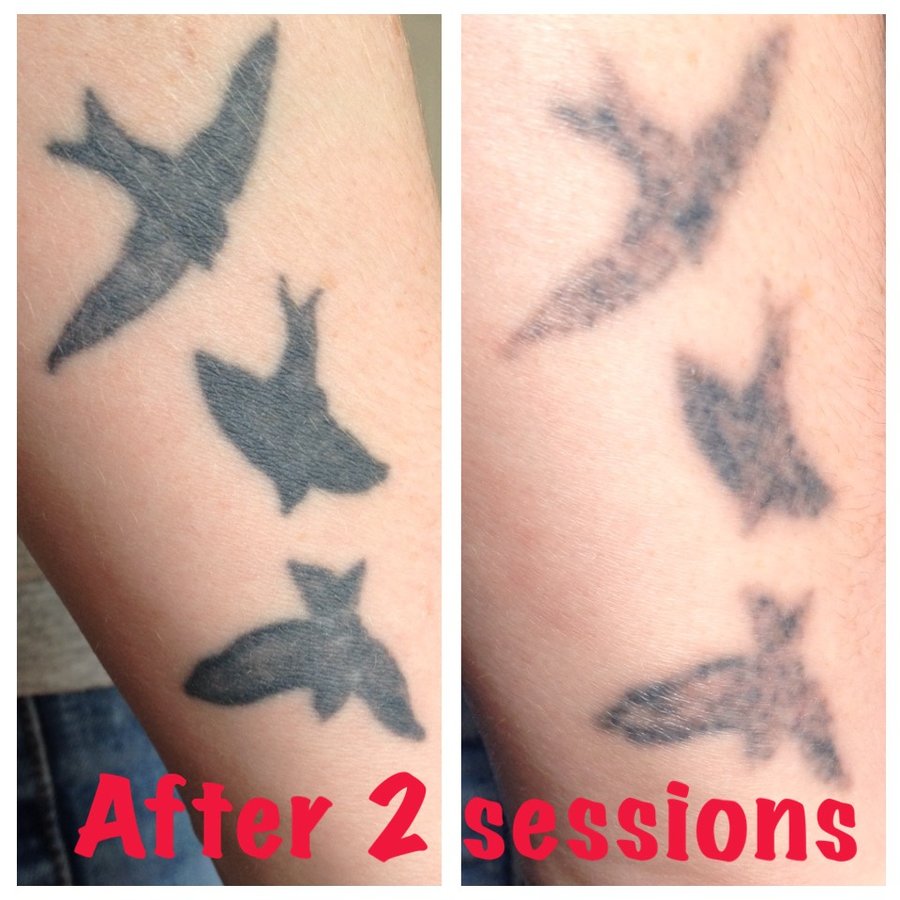 The Missing Ink: Laser Tattoo Removal - The Missing Ink: Laser Tattoo Removal