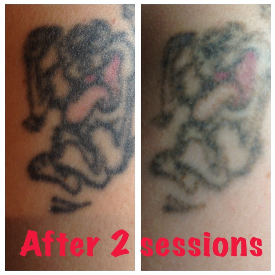 The Missing Ink: Laser Tattoo Removal - The Missing Ink: Laser Tattoo Removal