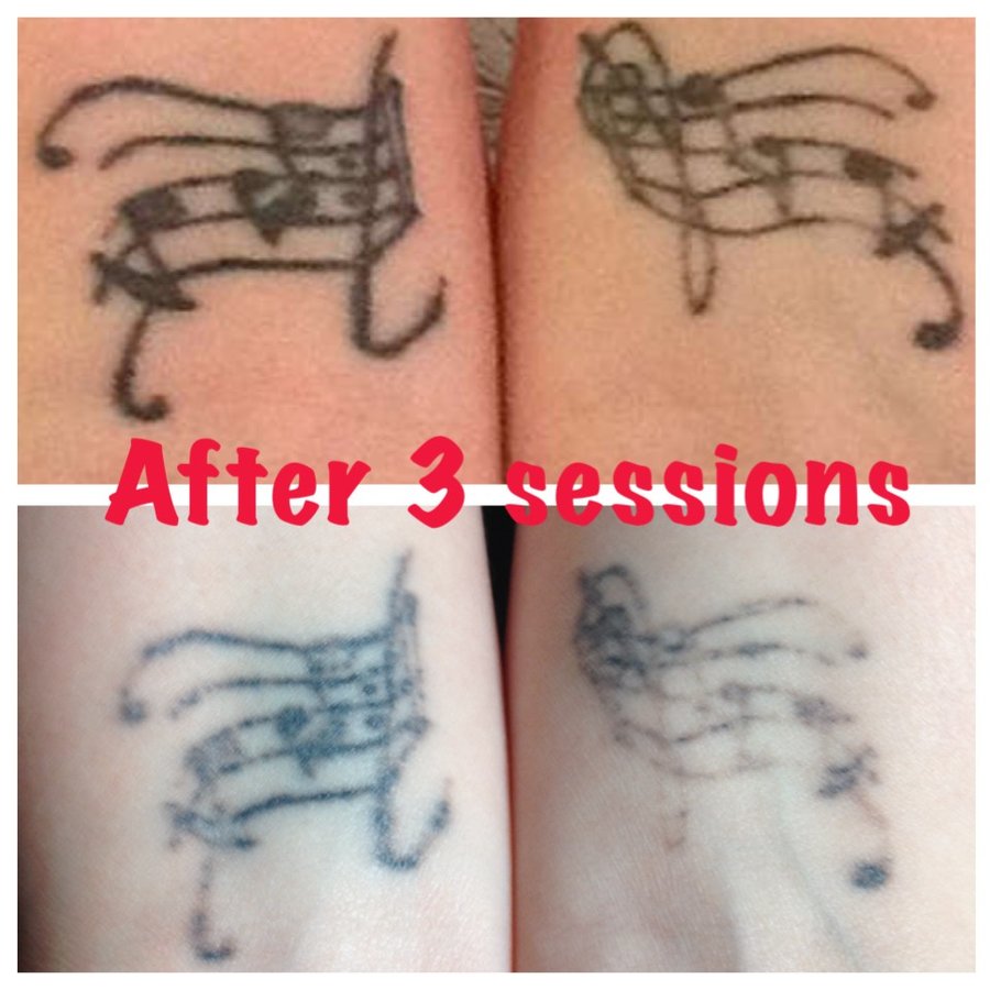 The Missing Ink: Laser Tattoo Removal - The Missing Ink: Laser Tattoo Removal