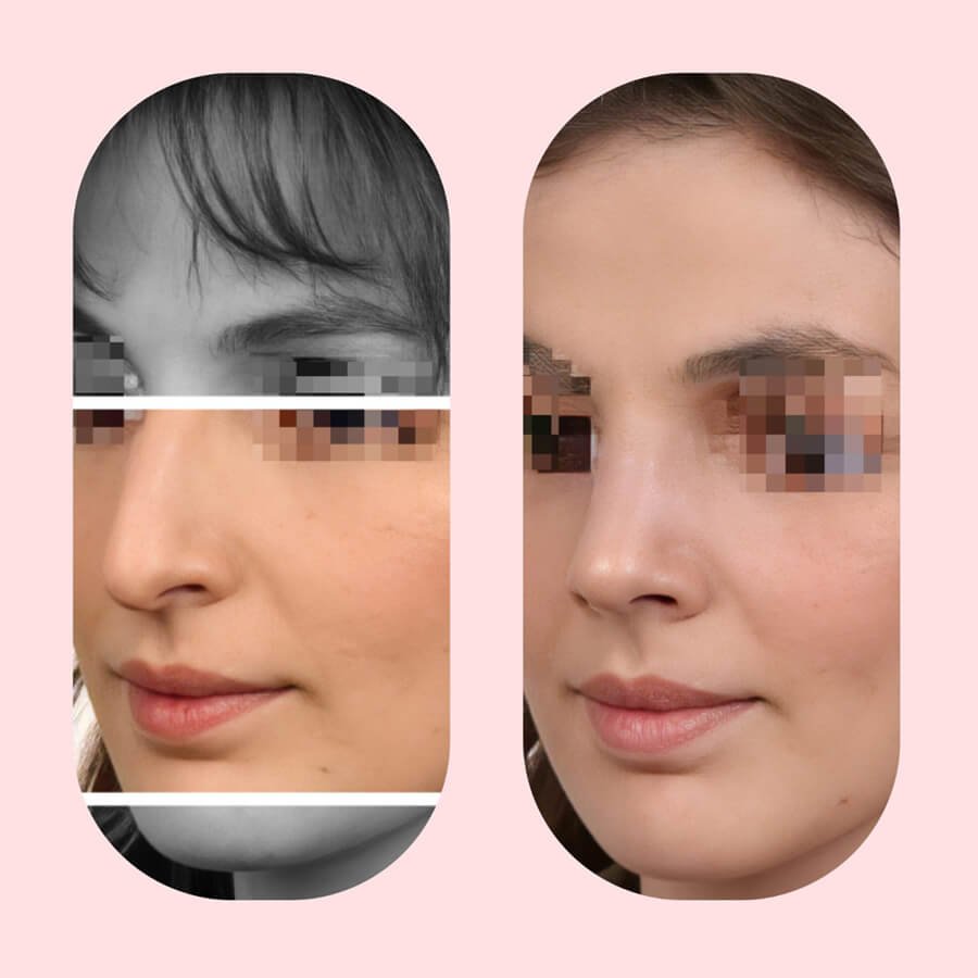 عيادة تجميل الأنف - Rhinoplast - The Nose Aesthetic Clinic - Rhinoplast