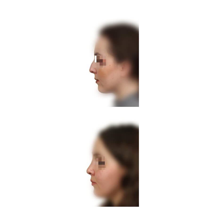 عيادة تجميل الأنف - Rhinoplast - The Nose Aesthetic Clinic - Rhinoplast