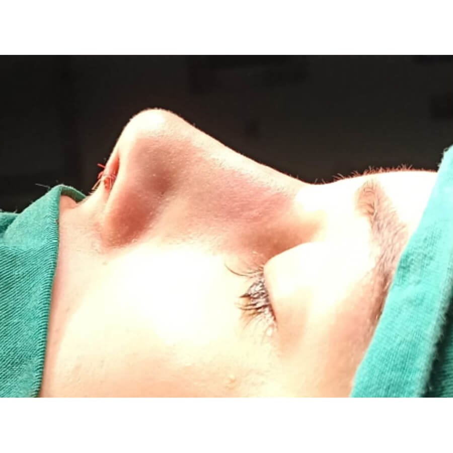 عيادة تجميل الأنف - Rhinoplast - The Nose Aesthetic Clinic - Rhinoplast
