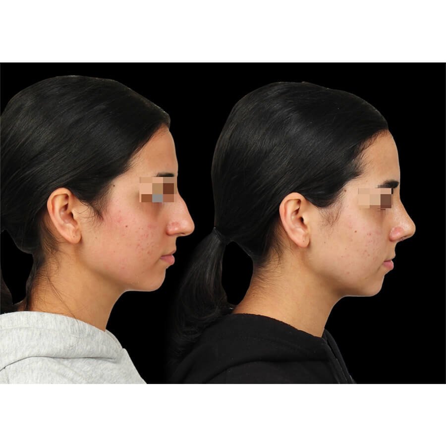 عيادة تجميل الأنف - Rhinoplast - The Nose Aesthetic Clinic - Rhinoplast