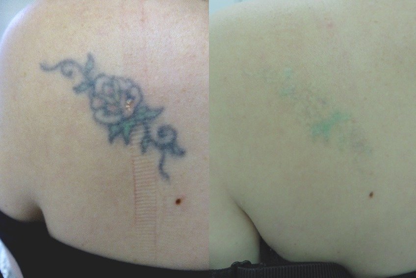 The Tattoo Removal Clinic - The Tattoo Removal Clinic