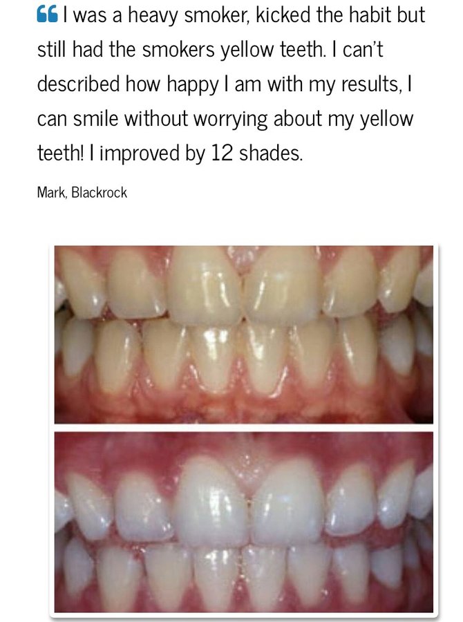 The Teeth Whitening Clinic Cork - The Teeth Whitening Clinic Cork