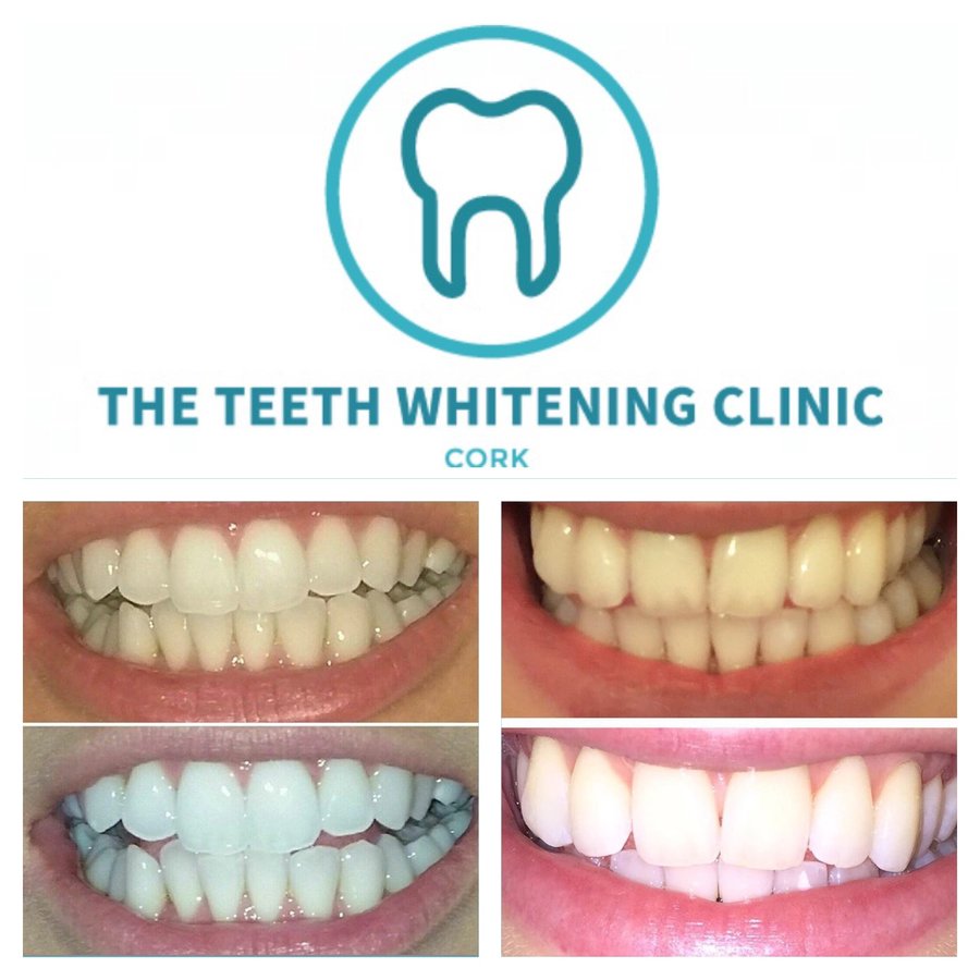 The Teeth Whitening Clinic Cork - The Teeth Whitening Clinic Cork
