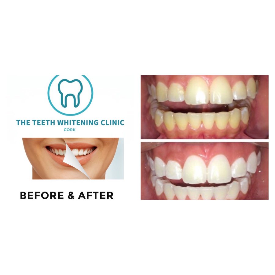 The Teeth Whitening Clinic Cork - The Teeth Whitening Clinic Cork