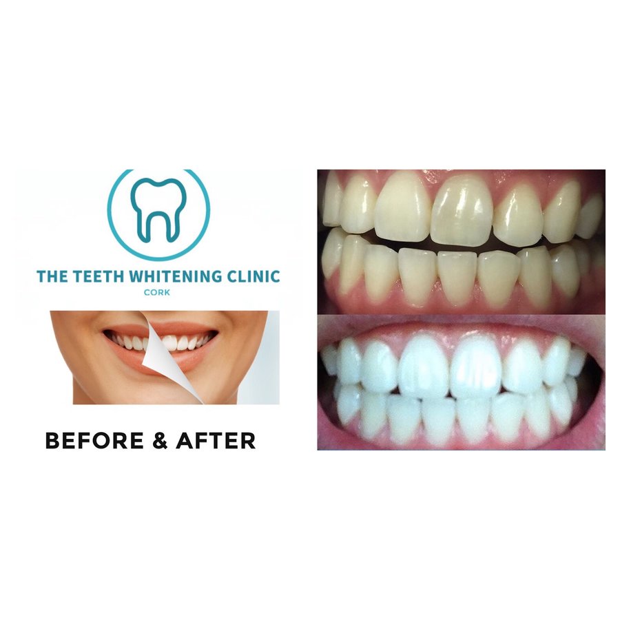 The Teeth Whitening Clinic Cork - The Teeth Whitening Clinic Cork