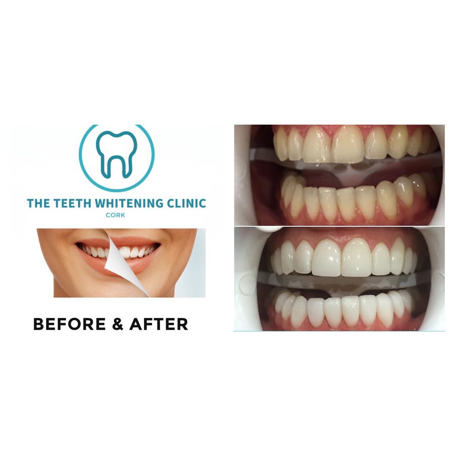 The Teeth Whitening Clinic Cork - The Teeth Whitening Clinic Cork