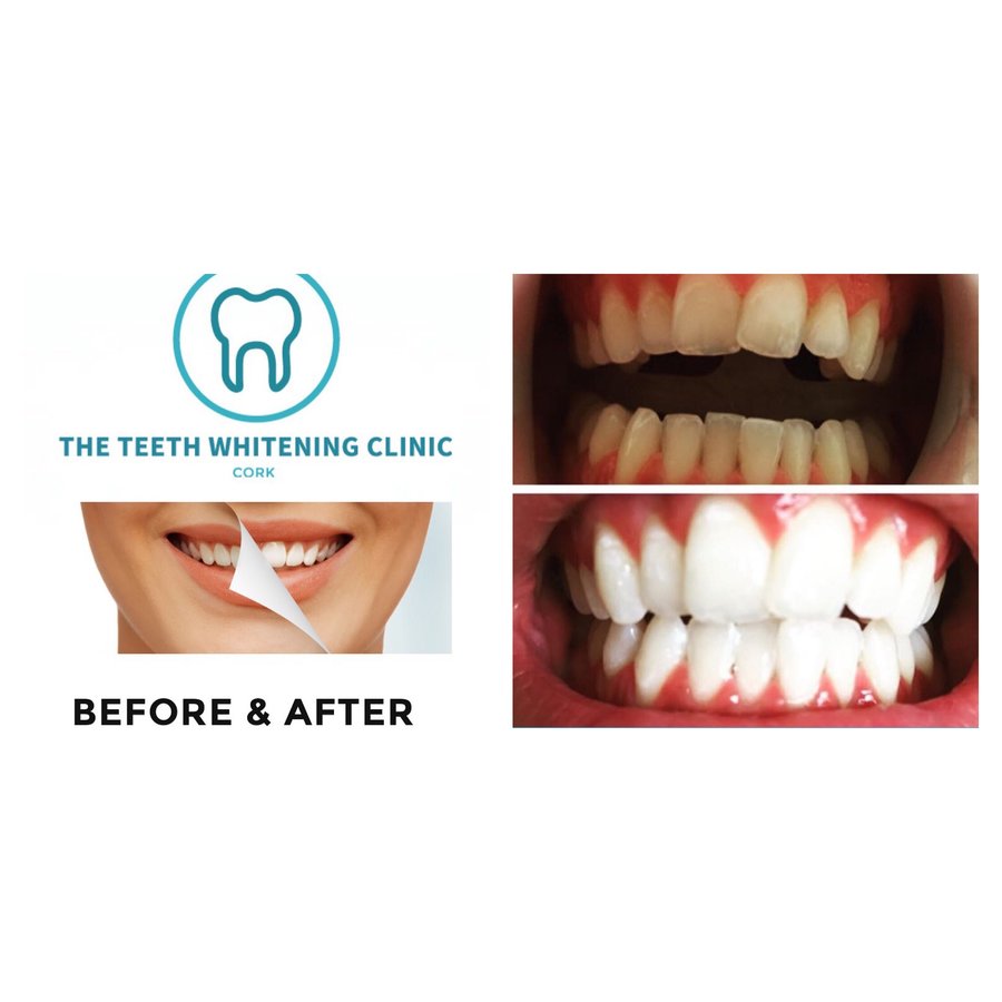 The Teeth Whitening Clinic Cork - The Teeth Whitening Clinic Cork