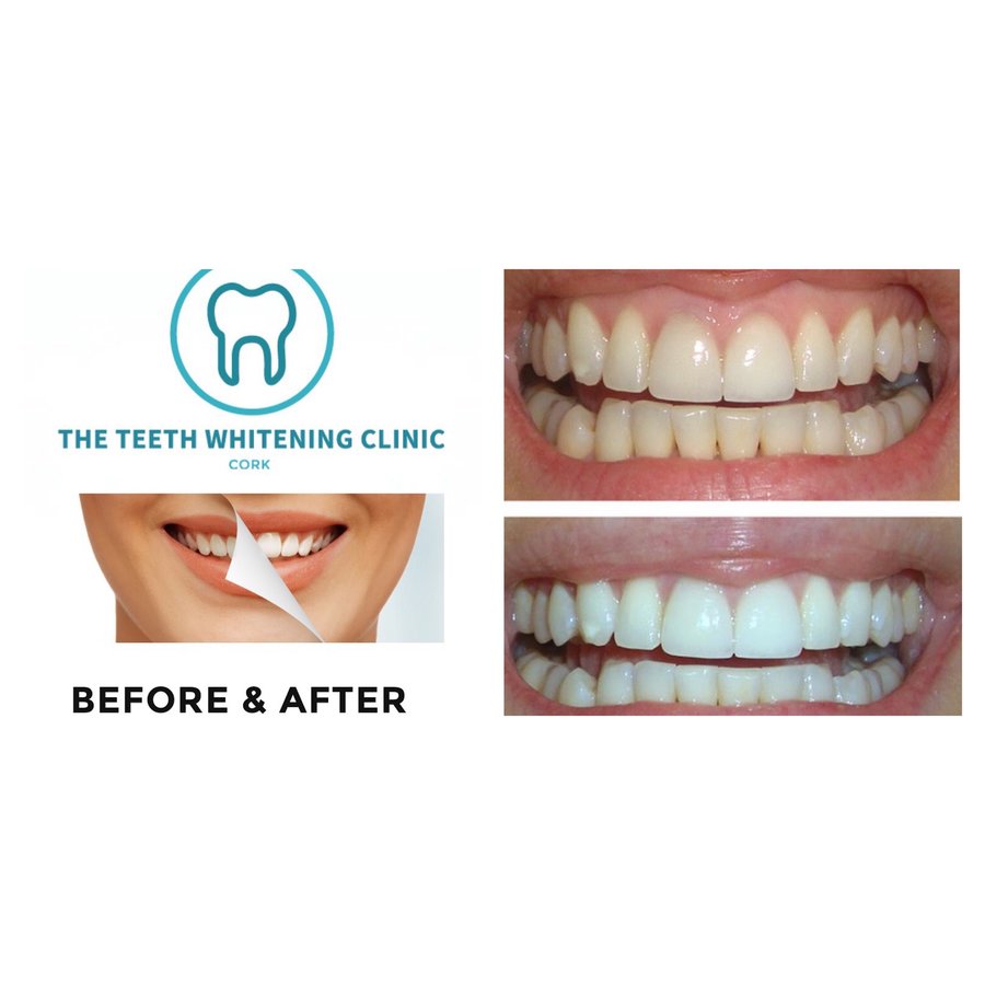 The Teeth Whitening Clinic Cork - The Teeth Whitening Clinic Cork