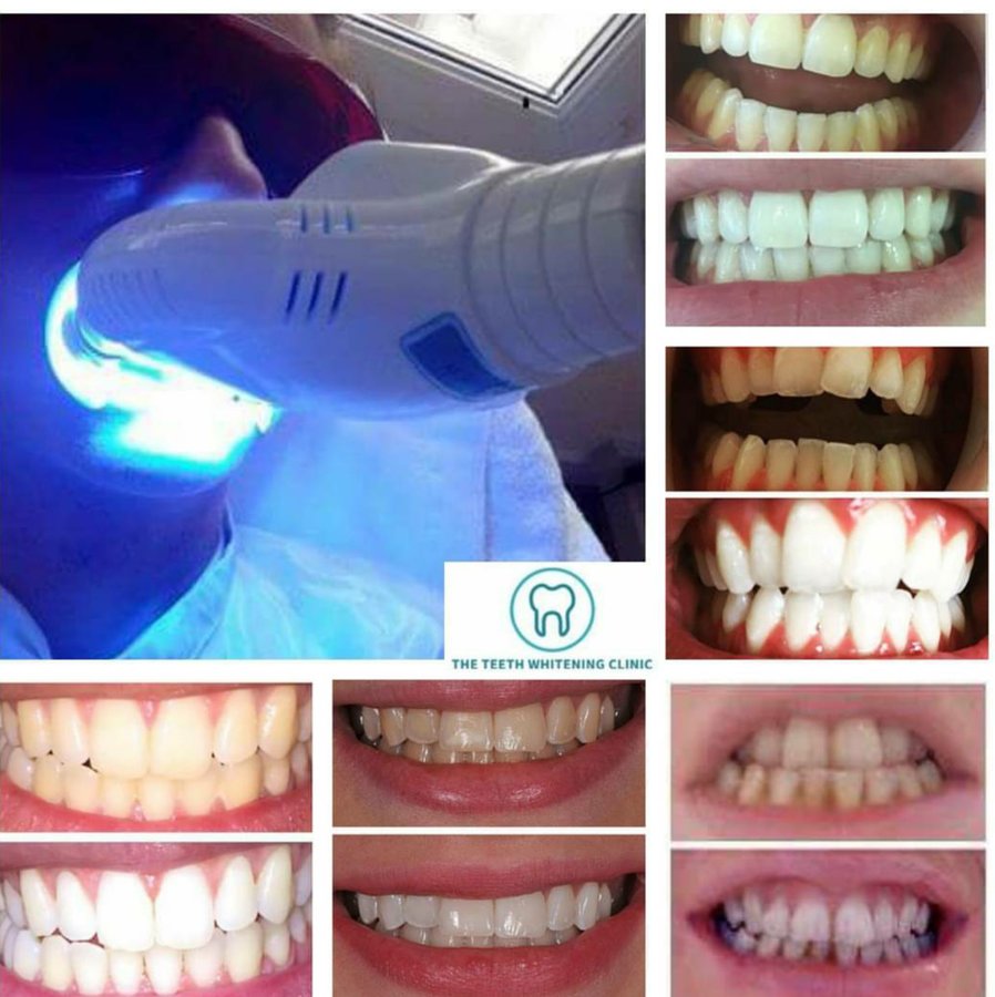 The Teeth Whitening Clinic Cork - The Teeth Whitening Clinic Cork