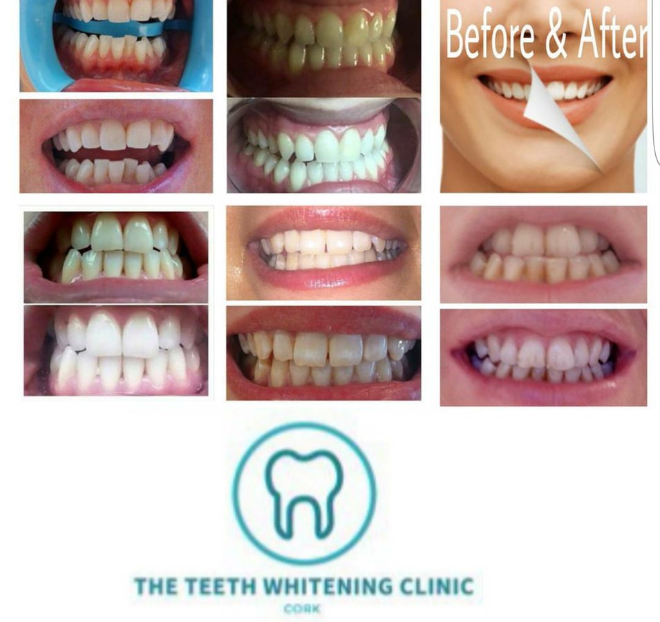 The Teeth Whitening Clinic Cork - The Teeth Whitening Clinic Cork