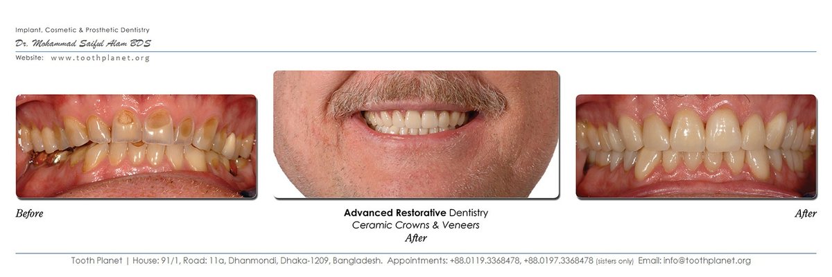 Tooth Planet - Tooth Planet