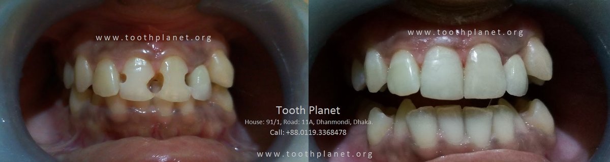 Tooth Planet - Tooth Planet