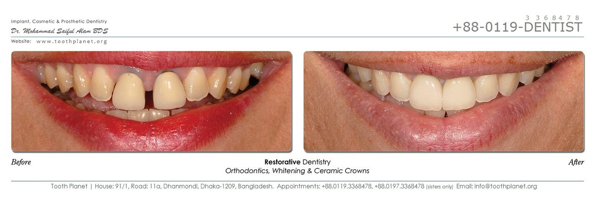 Tooth Planet - Tooth Planet