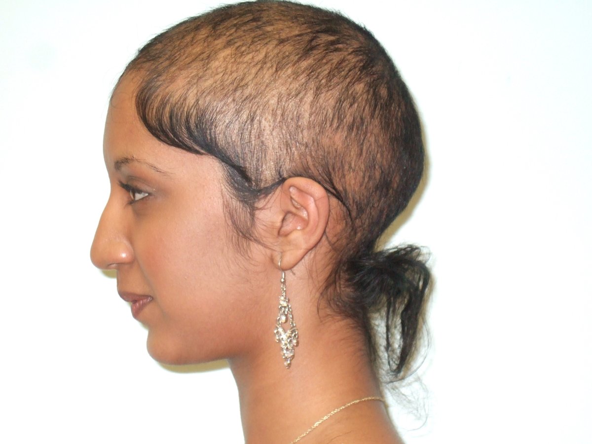 Total Hair Loss Solutions - Total Hair Loss Solutions