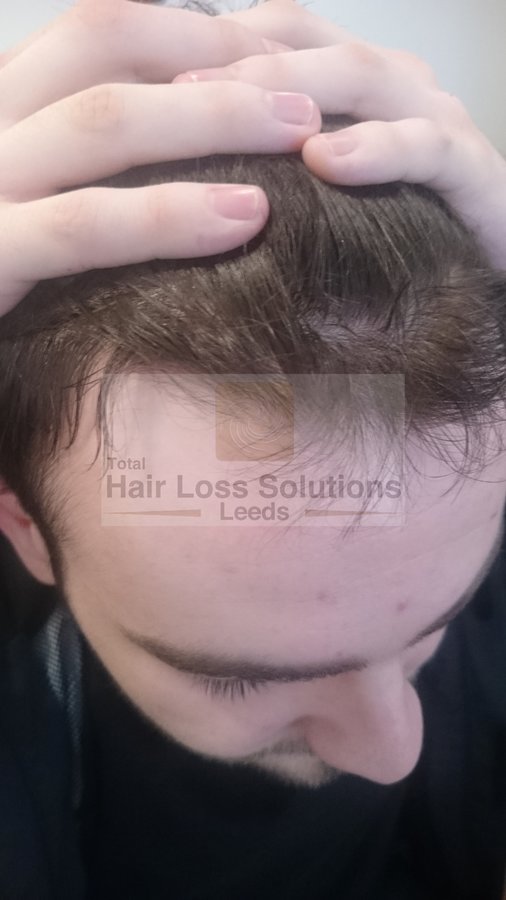 Total Hair Loss Solutions - Total Hair Loss Solutions