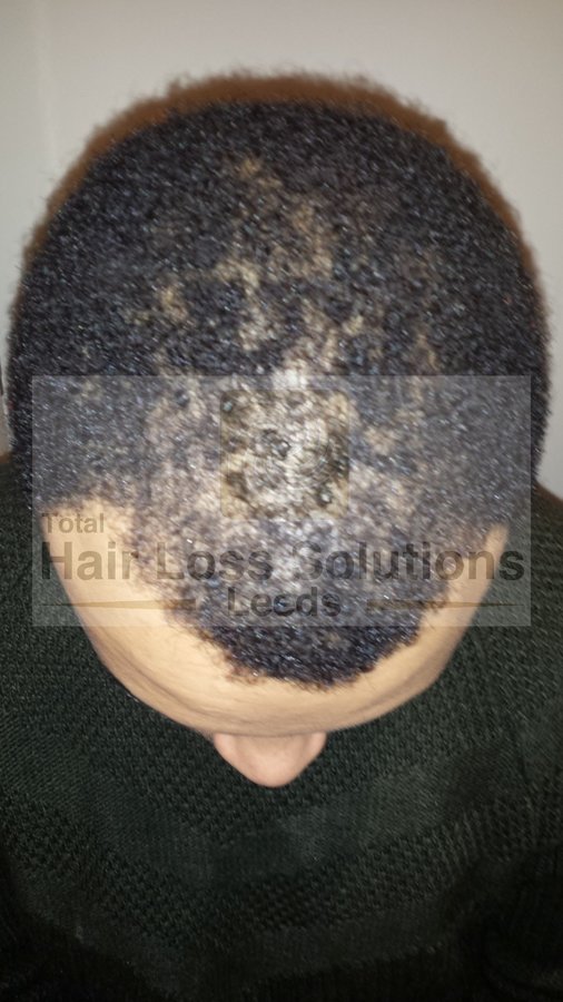 Total Hair Loss Solutions - Total Hair Loss Solutions