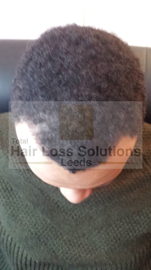 Total Hair Loss Solutions - Total Hair Loss Solutions