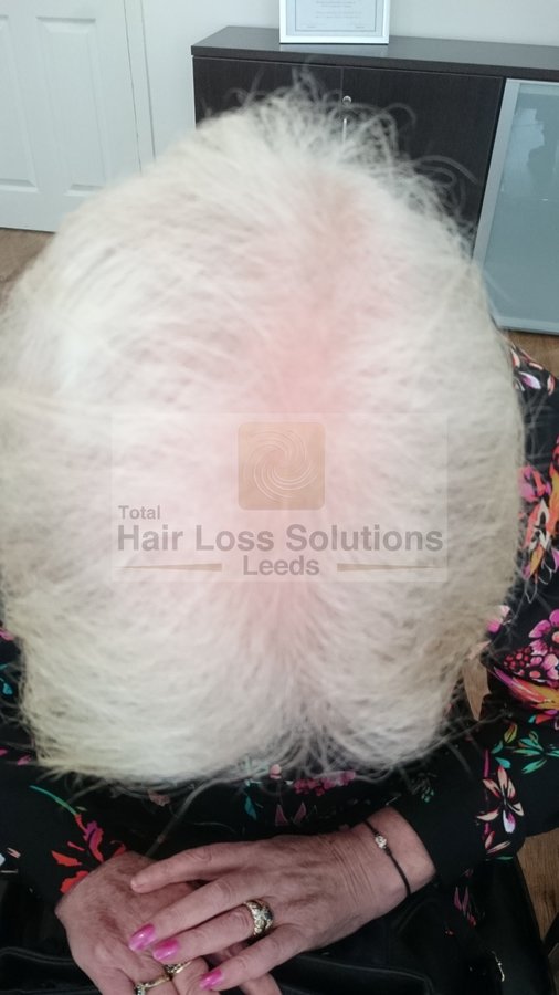 Total Hair Loss Solutions - Total Hair Loss Solutions