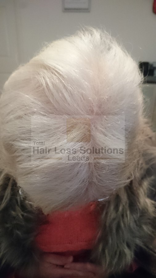Total Hair Loss Solutions - Total Hair Loss Solutions