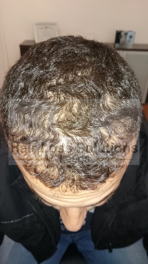 Total Hair Loss Solutions - Total Hair Loss Solutions