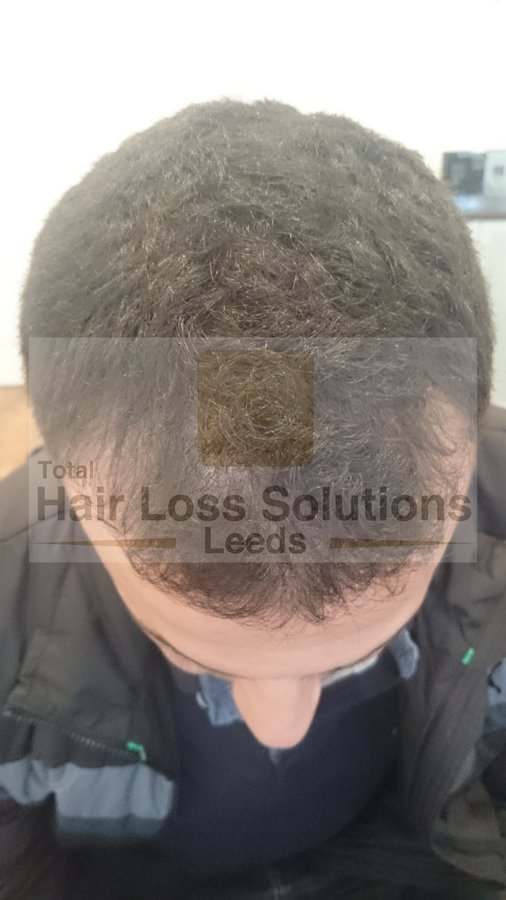 Total Hair Loss Solutions - Total Hair Loss Solutions