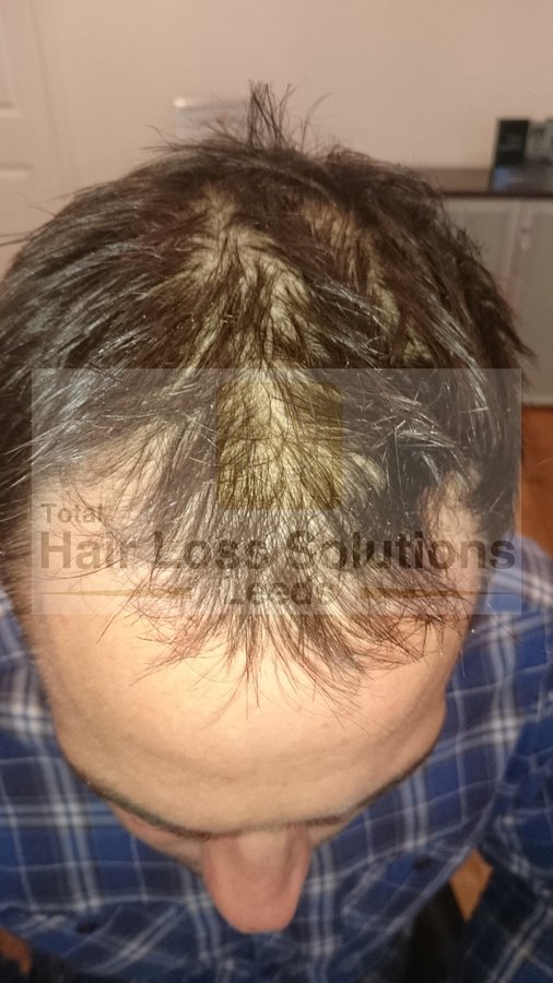 Total Hair Loss Solutions - Total Hair Loss Solutions