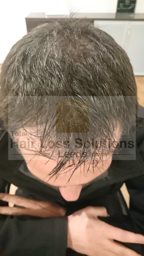 Total Hair Loss Solutions - Total Hair Loss Solutions