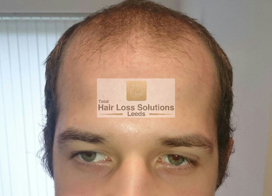 Total Hair Loss Solutions - Total Hair Loss Solutions