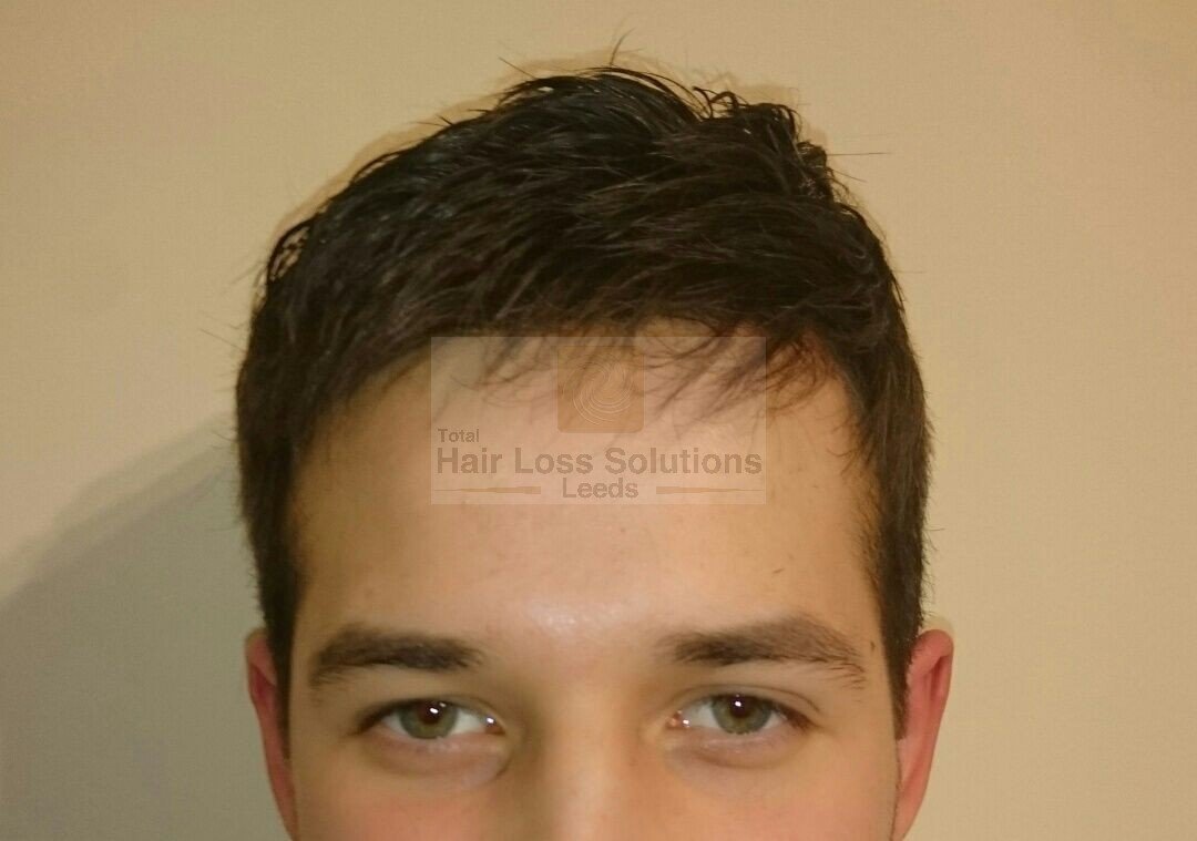 Total Hair Loss Solutions - Total Hair Loss Solutions