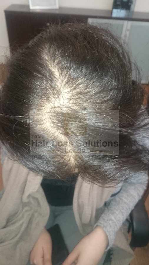 Total Hair Loss Solutions - Total Hair Loss Solutions