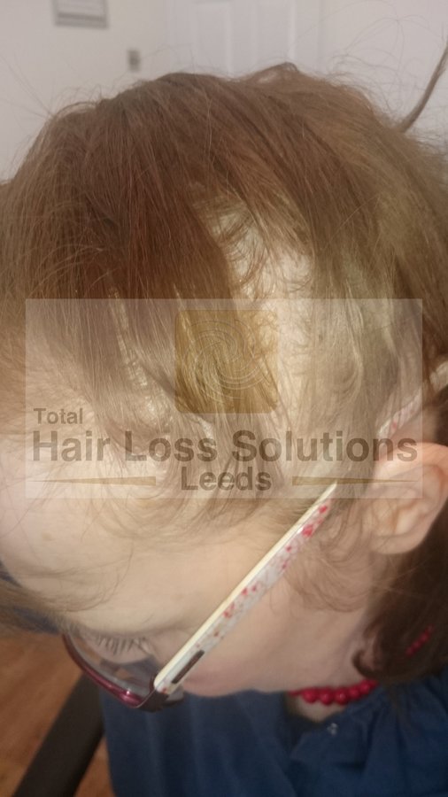 Total Hair Loss Solutions - Total Hair Loss Solutions
